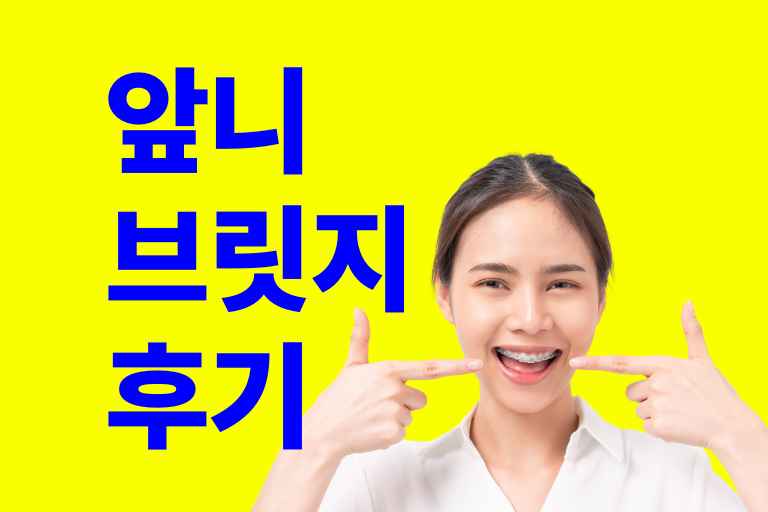 앞니브릿지 후기